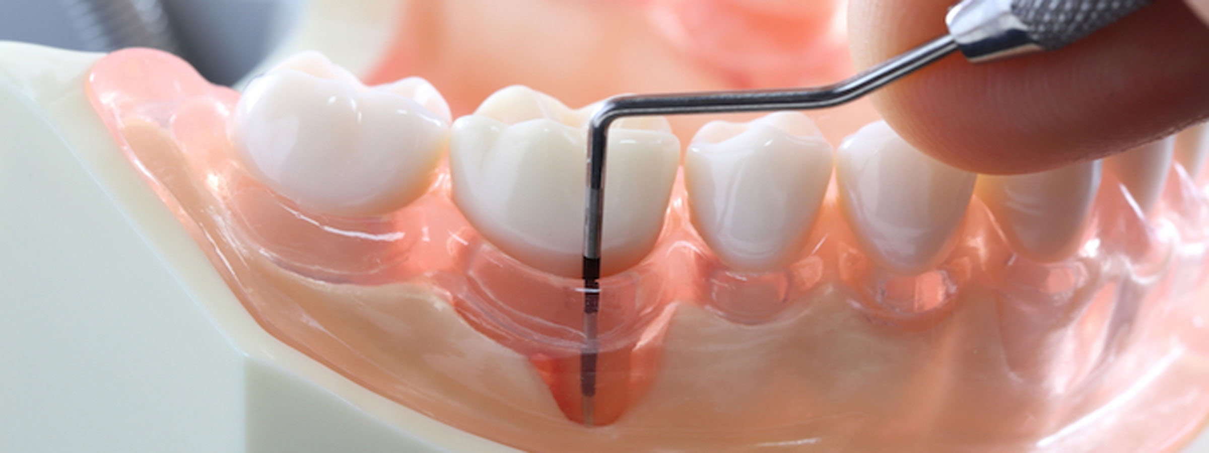 歯周デトックス療法